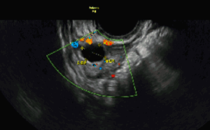 Antral Follicle Count Testing Explained: How Clinics Measure AFC | Seen ...