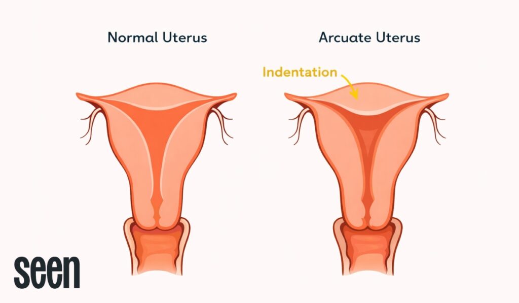 What is an arcuate uterus? Arcuate uterus compared to normal uterus